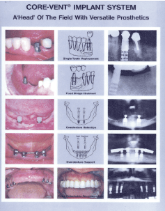    Core-Vent Implant
            System 1984